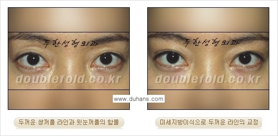 [두한성형외과 경쟁력 눈성형] - [미세지방이식으로 두꺼운 쌍꺼풀 라인의 교정 방법 안내] 관련 이미지 11