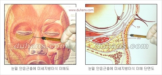 [두한성형외과 경쟁력 안검성형] - [젊은 눈매 안검성형의 여러 가지 방법 안내] 관련 이미지 66