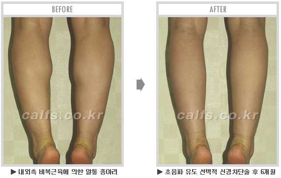 [종아리성형 두한성형외과] - [종아리수술에 대한 자주하는 질문과 답변 모음] 관련 이미지 68