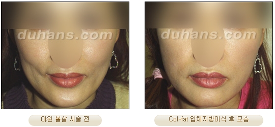 [Duhan Plastic Surgery Facial Autologous Fat Grafting] - [Fat Grafting Guide] image 32