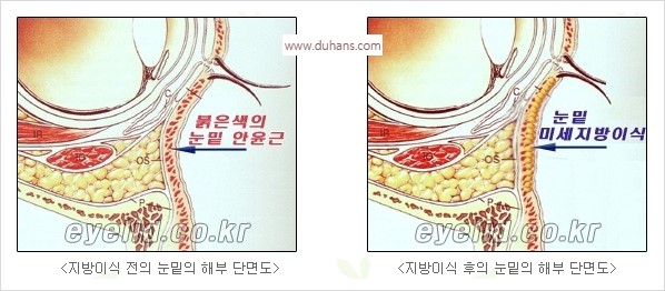 [두한성형외과 경쟁력 눈밑성형] - [눈밑 다크써클 수술 방법] 관련 이미지 5