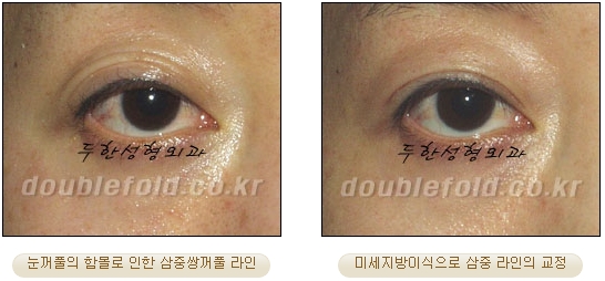 [두한성형외과 눈재수술] - [재수술 방법들] 관련 이미지 30