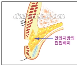 [Doohan Plastic Surgery Double Eyelid Revision Surgery] - [Double Eyelid Revision Surgery Process] image 21