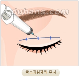 눈성형잘하는곳 두한성형외과 - 겹쌍꺼풀 관련 이미지 7