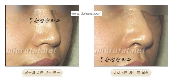 [두한성형외과 경쟁력 코성형] - [미세지방이식을 이용한 자연스러운 코성형 안내] 관련 이미지 10