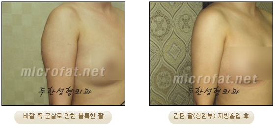 두한성형외과 지방흡입 - 부위별 안전 지방흡입 관련 이미지 25