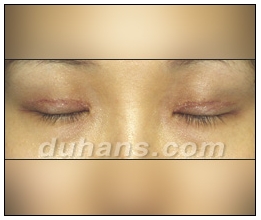 Candidates for Double Eyelid Revision Surgery: Unattractive Double Eyelids, Beautiful Double Eyelids image 9