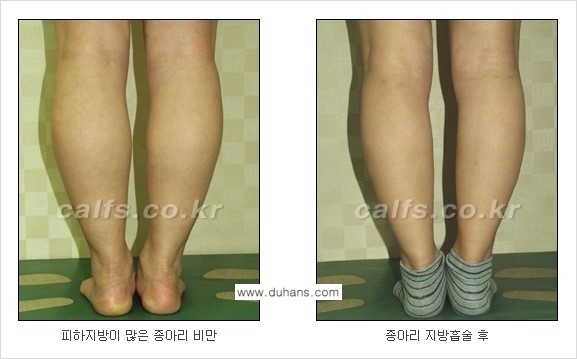 [두한성형외과 경쟁력 종아리성형] - [종아리 지방흡입 2.] 관련 이미지 5