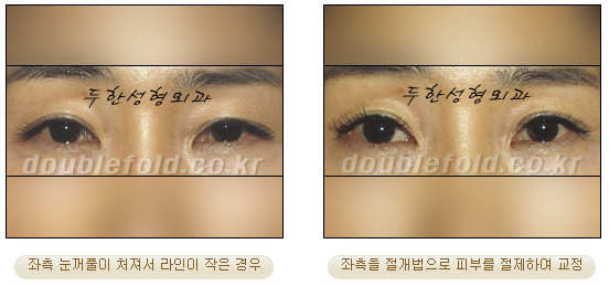 [Duhan Plastic Surgery Eye Surgery] - [Asymmetric Line, Eyelash Eversion, Deep Fixation] image 11