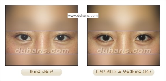 [두한성형외과 경쟁력 미세지방이식] - [눈밑 애교살을 위한 미세지방이식 1.] 관련 이미지 9