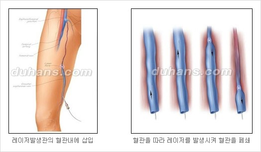 [두한성형외과 경쟁력 정맥류 치료] - [정맥류 치료의 모든 것] 관련 이미지 18