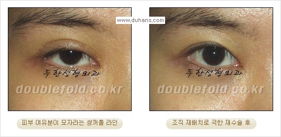 ​[두한성형외과 경쟁력 쌍꺼풀 재수술, 극한 눈재수술] - [쌍꺼풀 재수술시 지나친 아웃폴드 라인, 과도한 앞트임, 피부가 모자라 토안증 발생했을 경우 문제] 관련 이미지 3