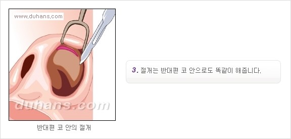 [두한성형외과 경쟁력 코성형] - [코성형을 위한 알로덤(슈어덤) 수술, 실리콘 수술 안내] 관련 이미지 6