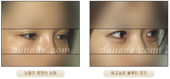 [두한성형외과 얼굴자가지방이식] - [눈밑 애교살 시술을 위한 미세지방이식] 관련 이미지 1