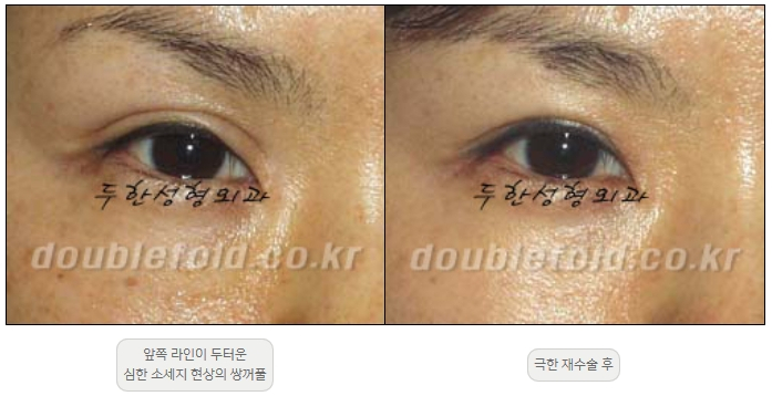 [Duhan Plastic Surgery Double Eyelid Revision] - [Thick Double Eyelid Line] image 34