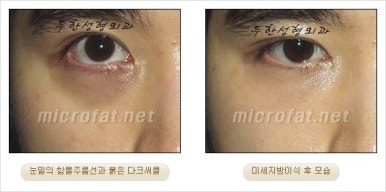 두한성형외과 눈밑수술 - 다크서클 수술 전후 관리 안내 관련 이미지 36