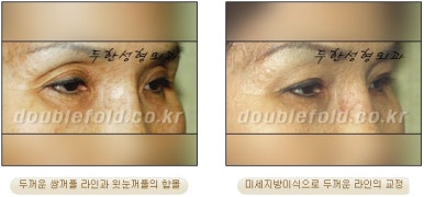 [두한성형외과 쌍커풀수술] - [쌍꺼풀지방이식] 관련 이미지 19