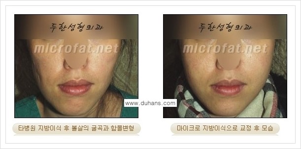 [두한성형외과 경쟁력 윤곽성형] - [볼, 볼살 지방이식] 관련 이미지 36