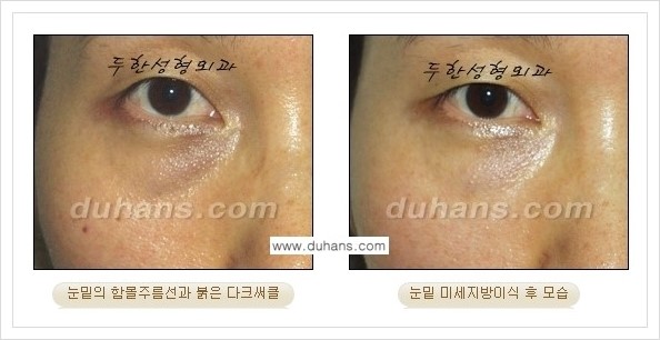 [두한성형외과 경쟁력 눈밑성형] - [꺼진 눈밑, 눈밑 함몰 주름선 눈밑 미세지방이식 안내] 관련 이미지 12