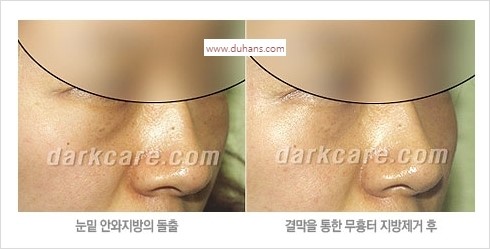 [두한성형외과 경쟁력 눈밑성형] - [눈밑 안와지방 돌출의 무통마취 무흉터 눈밑지방제거 안내] 관련 이미지 7