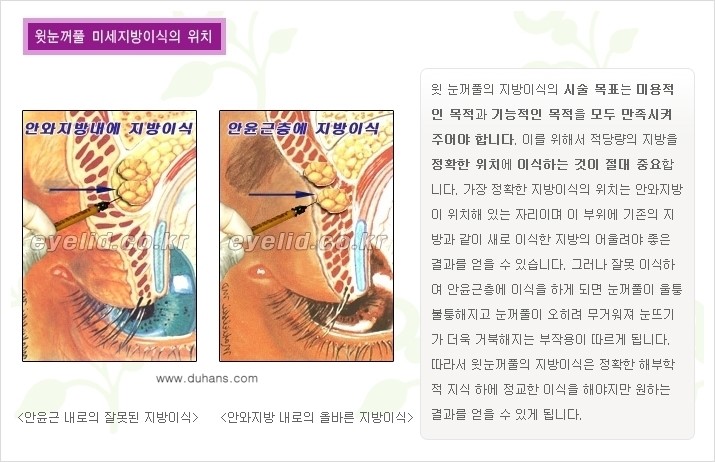 [두한성형외과 경쟁력 미세지방이식] - [꺼진(함몰된) 윗눈꺼풀 미세지방이식] 관련 이미지 4