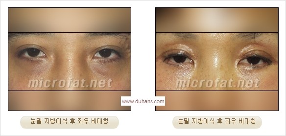 [두한성형외과 경쟁력 미세지방이식] - [타 병원의 지방이식 부작용 교정 - 정교한 마이크로 지방이식, 흡입 안내] 관련 이미지 6