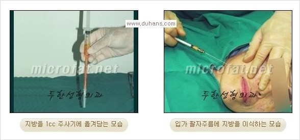 [두한성형외과 경쟁력 주름성형] - [입가주름과 코옆 팔자주름제거 지방이식 시술의 효과] 관련 이미지 8