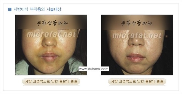 ​[두한성형외과 경쟁력 미세지방이식] - [타병원에서의 미세지방이식 부작용 종류와 문제점 안내] 관련 이미지 2