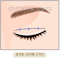 눈성형잘하는곳 두한성형외과 - 겹쌍꺼풀 관련 이미지 6