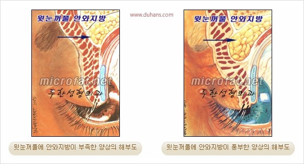 [두한성형외과 경쟁력 눈성형 리더] - [윗눈꺼풀 함몰( #꺼진눈꺼풀) 미세지방이식과 상안검성형]#꺼진눈성형 , #눈위함몰 관련 이미지 2