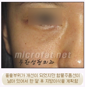 [두한성형외과 지방이식] - [다크써클, 눈​밑주름] 관련 이미지 42