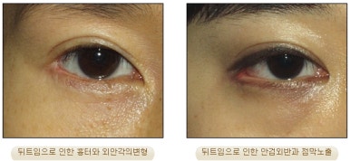 [Duhan Plastic Surgery Eyelid Surgery] - [Epicanthoplasty, Medial Canthoplasty] image 22