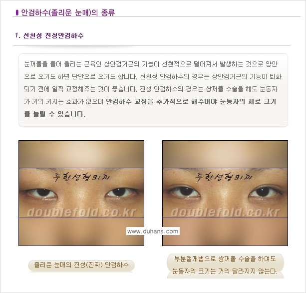 [두한성형외과 NO.1 "극한 눈(쌍꺼풀 재수술)"] - [안검하수(졸린눈매) 재수술 안내 1.] 관련 이미지 3