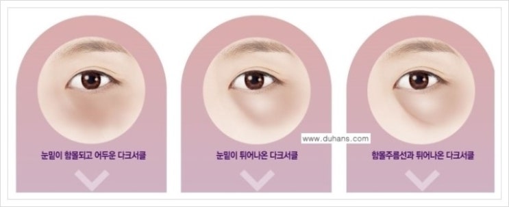 [두한성형외과 경쟁력 다크써클 교정] - [다크써클 5단계로 이뤄지는 핵심 5 STEP SOLUTION 안내 1.] 관련 이미지 7