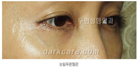 두한성형외과 보기싫은 혈관제거 - 눈밑혈관, 손과 팔의 혈관확장증 치료 관련 이미지 3
