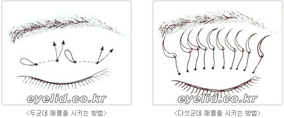 [두한성형외과 눈성형] - [쌍꺼풀수술의 절개법, 매몰법] 관련 이미지 5