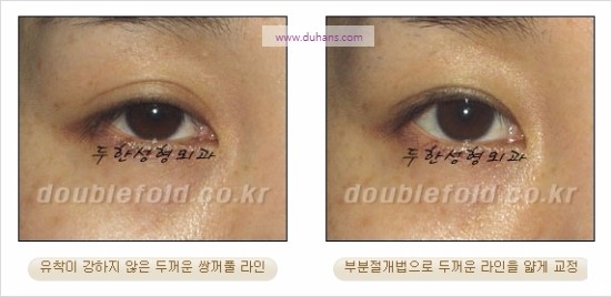 [두한성형외과 경쟁력 눈성형] - [쌍꺼풀 재수술에 대한 최선의 대안 제시] 관련 이미지 28