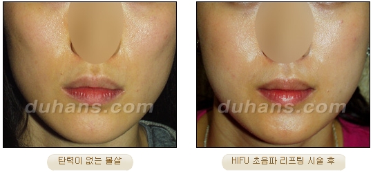 [Duhan Plastic Surgery Lift] - [Double Chin, Drooping Cheeks, Sagging Neck Skin, Wrinkle Improvement] image 21