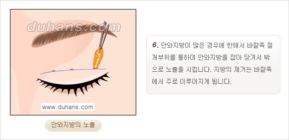 [두한성형외과 경쟁력 눈성형] - [쌍꺼풀 재수술 방법 - 부분절개법(Partial incision method) 과정 안내] 관련 이미지 7
