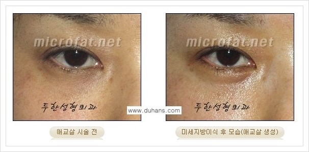 [두한성형외과 경쟁력 눈밑성형] - [눈밑 애교살 미세지방이식 안내] 관련 이미지 7