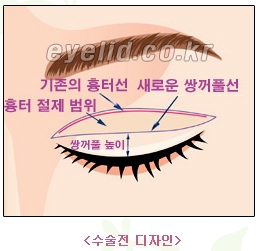 [두한성형외과 쌍꺼풀재수술] - [쌍꺼풀재수술성공요건, 쌍꺼풀재수술과정] 관련 이미지 3