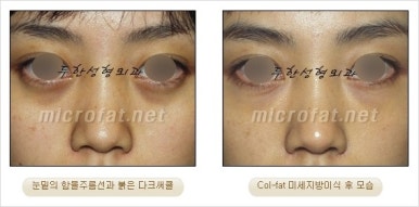 두한성형외과 눈밑수술 - 다크서클 수술 전후 관리 안내 관련 이미지 22