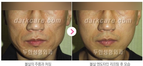 Duhan Plastic Surgery Combo Program - Dark Circles and Lifting image 17