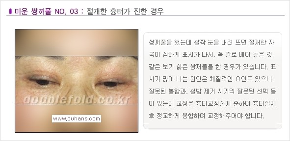 [두한성형외과 경쟁력 쌍꺼풀 재수술, 극한 재수술] - [일반적인 기준의 미운 쌍꺼풀과 아름다운 쌍꺼풀 안내] 관련 이미지 3