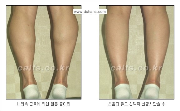 ​[두한성형외과와 날씬한 종아리 만들기!] - [간편하고 안전한 종아리 축소방법 ④] 관련 이미지 6
