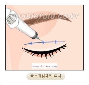 [두한성형외과 경쟁력 눈성형] - [자연스럽고 아름다운 눈매를 만드는 여러 가지 눈성형 방법] 관련 이미지 5