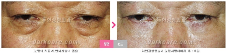 [두한성형외과 다크서클] - [다크서클 전후사진 검증] 관련 이미지 139