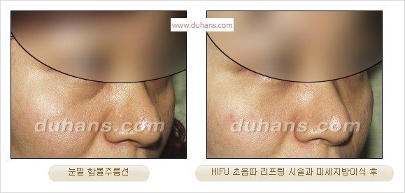 [두한성형외과 경쟁력 주름성형] - [주름제거를 위한 리프팅] 관련 이미지 56