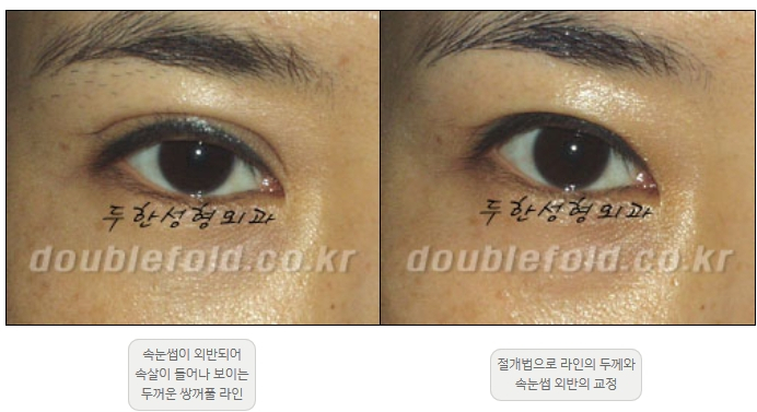 [Double Eyelid Surgery Duhan Plastic Surgery] - [Revision Methods] image 34