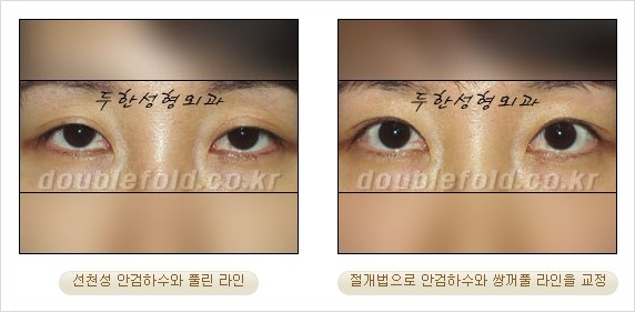 [두한성형외과 경쟁력 눈성형] - [안검하수(졸리운 눈매) 교정 방법 안내] 관련 이미지 20